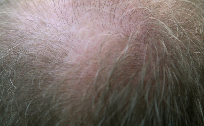 Chute des cheveux : Comment endiguer ce processus?