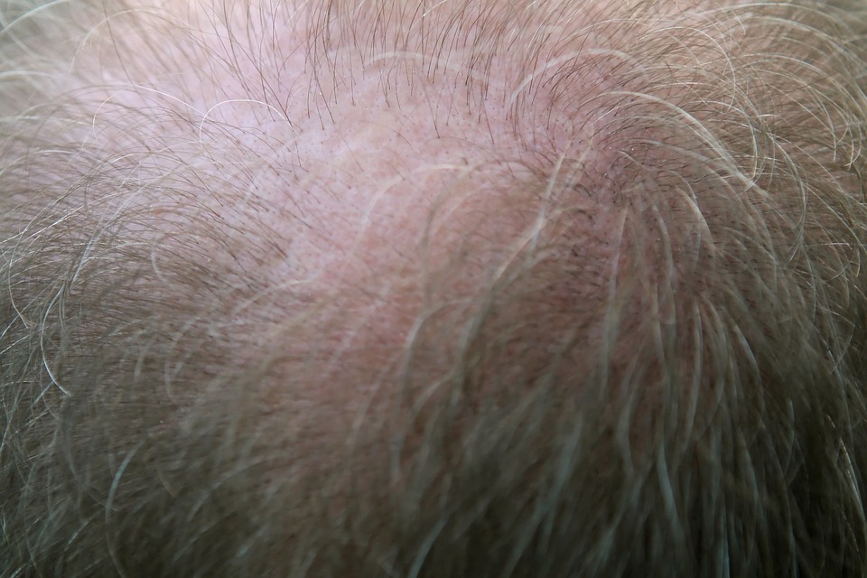 Chute des cheveux : Comment endiguer ce processus?