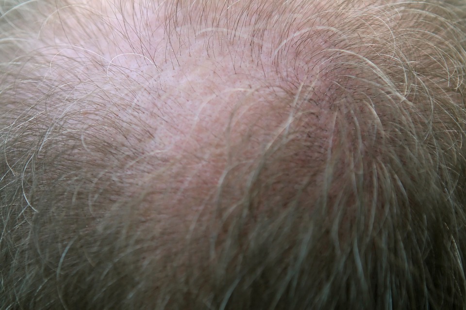 Chute des cheveux : Comment endiguer ce processus?