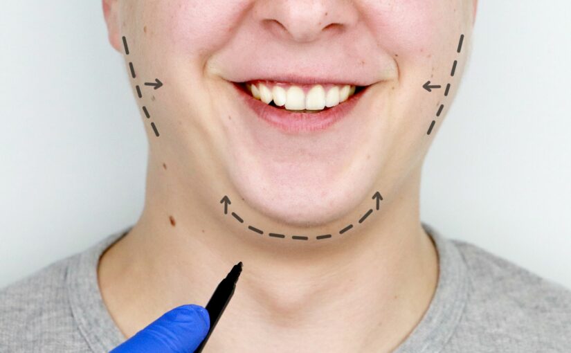 Modifier votre menton disgracieux grâce à la génioplastie !
